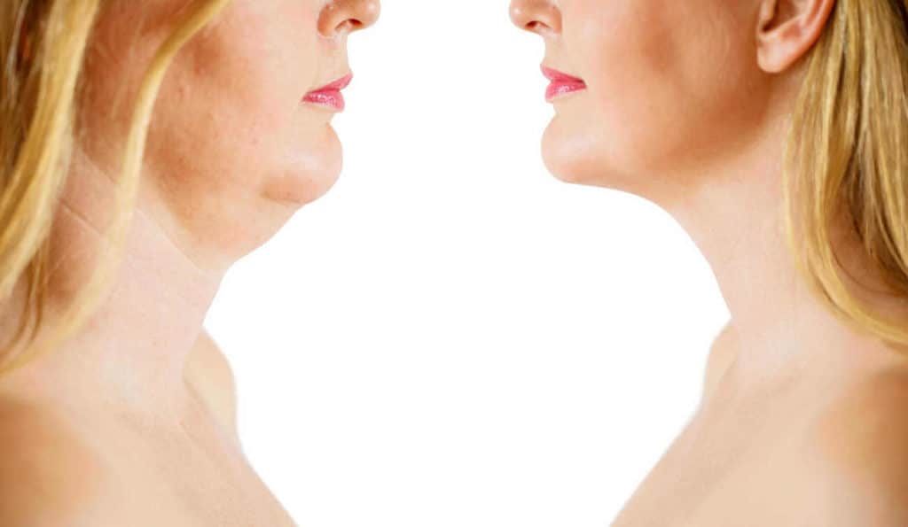 Double Chin treatment Worcester Park before and after results