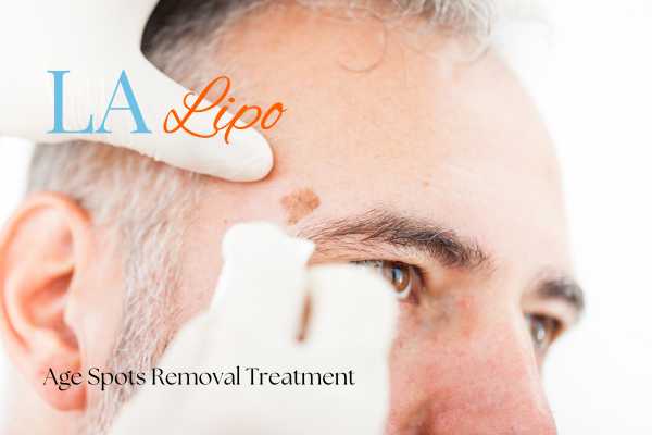 What Are the Most Effective Treatments for Age Spots Worcester Park?