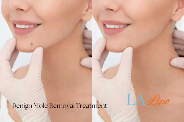 woman's before and after mole removal Worcester Park results