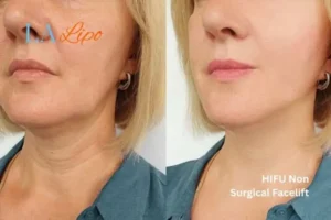 hi-fu for wrinkles Worcester Park before and after results