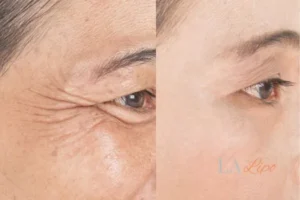 Before and after results of woman - HI-fu wrinkles reduction treatment Worcester Park
