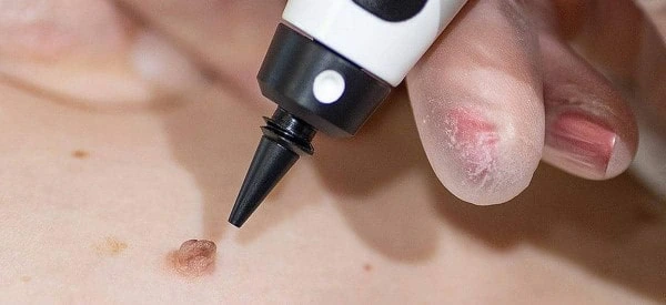 skin tag removal using cryopen Worcester Park