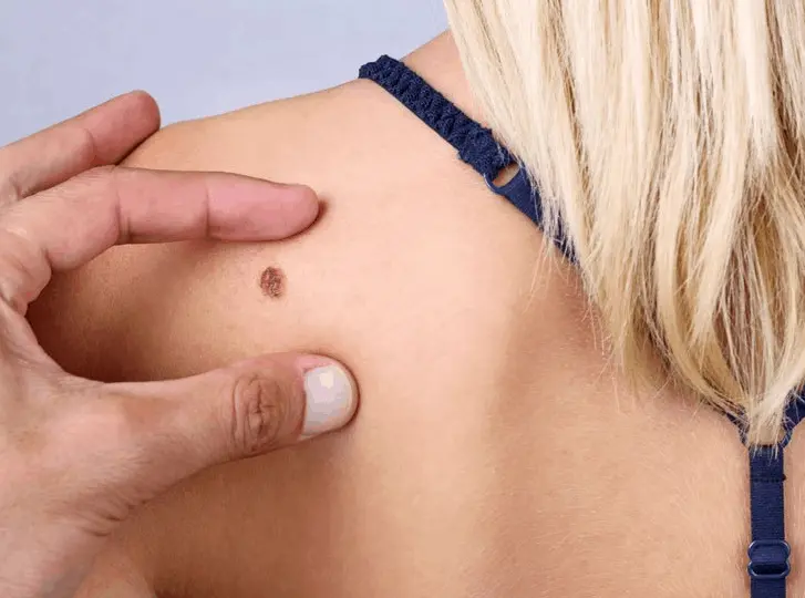 woman having mole removal Worcester Park consultation before treatment.