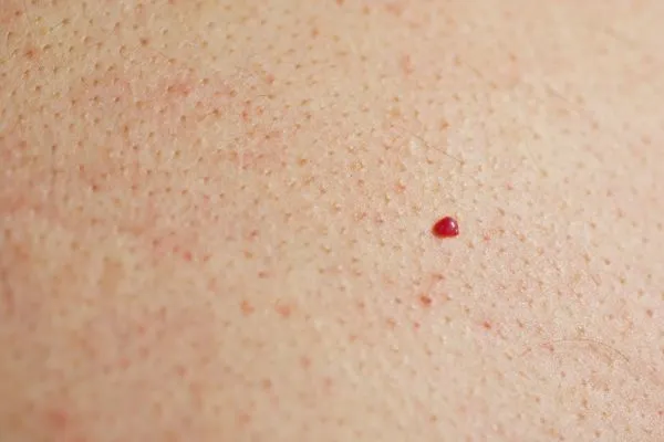 close up of a cherry angioma Worcester Park