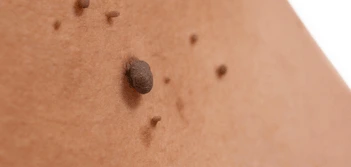 image of a skin tag Worcester Park