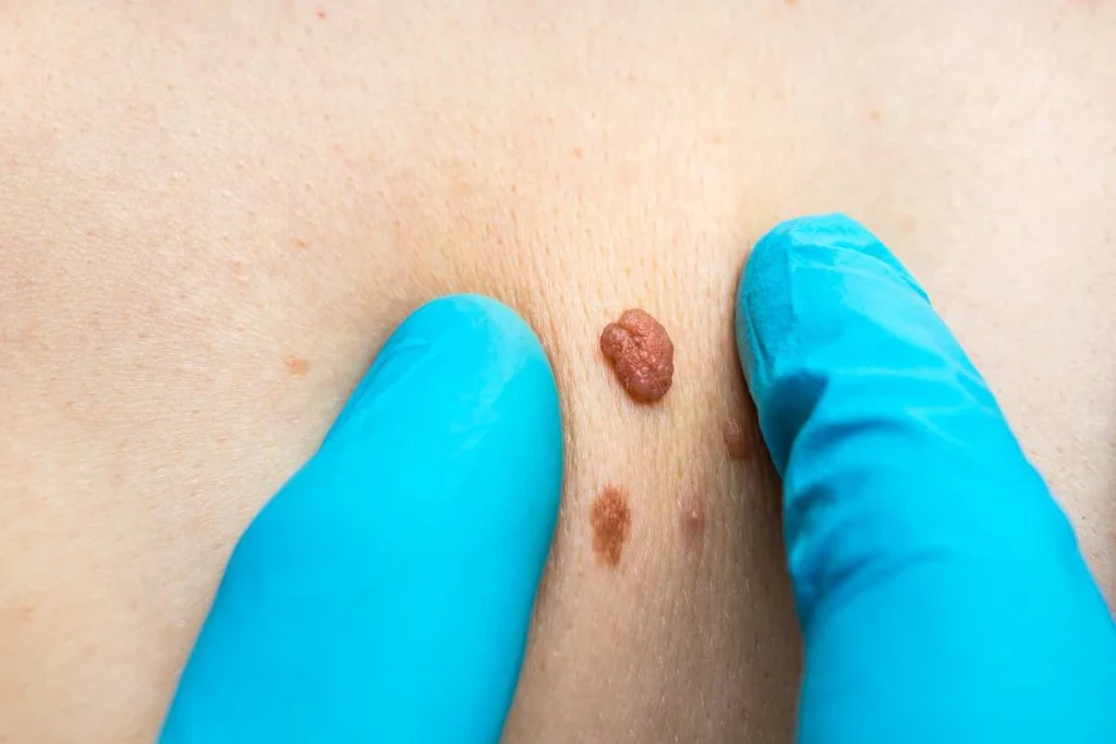 Consultant examining a skin tag Worcester Park