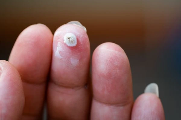 wart on person finger - cryotherapy to treat from LA LIPO Worcester Park