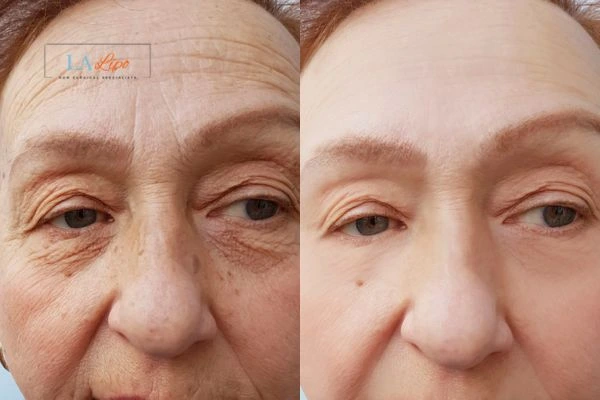 The powerful benefits of Morpheus8 Treatment Worcester Park - Call Our team today!