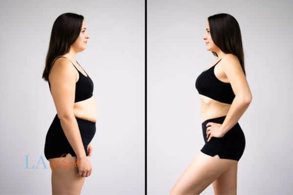 Picture of womans before and after using LA-EMS body sculpting to improve her core strength Worcester Park