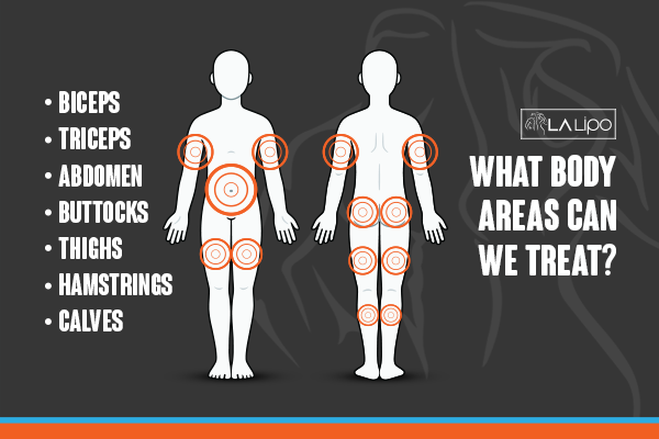 Diagram to show areas you can have LA-EMS Body Sculpting Treatment Worcester Park