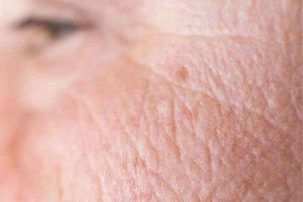 close up picture of a woman's face showing an age spot Worcester Park