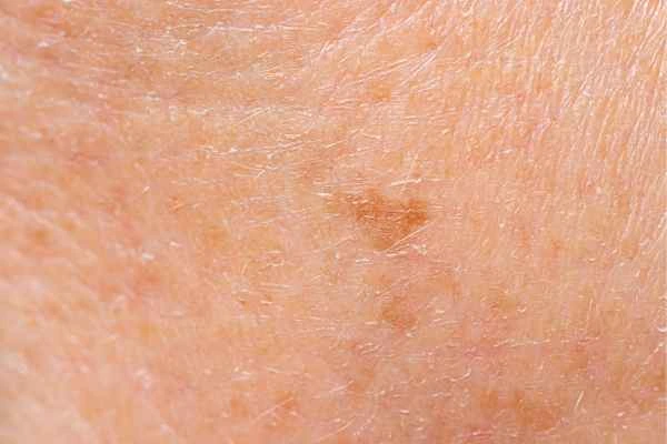 close up picture of age spots Worcester Park