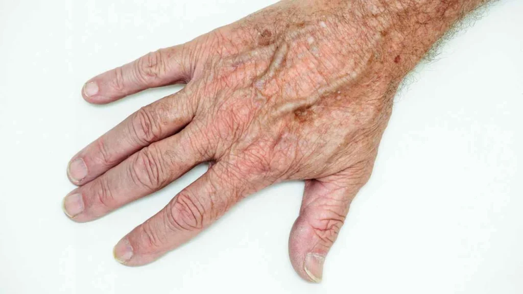 Male hand showing age spot Worcester Park