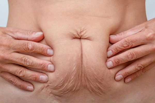 Should I Combine Diastasis Recti Treatment with Body Contouring for Better Results Worcester Park?