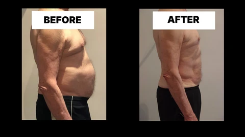 What Symptoms Can Diastasis Recti Cause in Men? Weak Core, Back Pain and Poor Posture Worcester Park